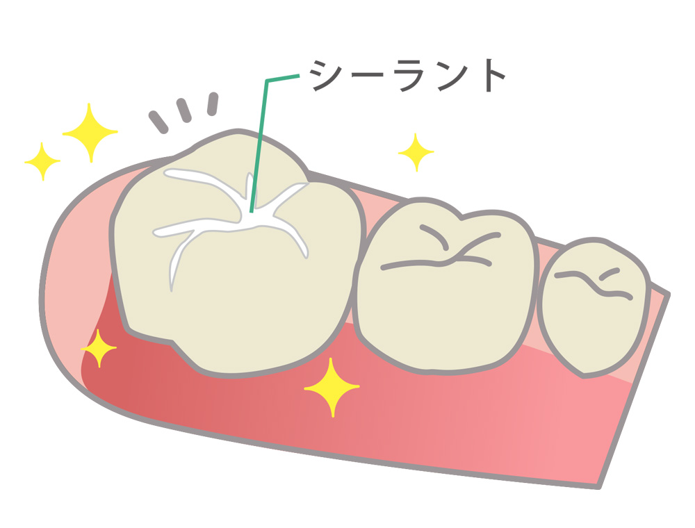 シーラント